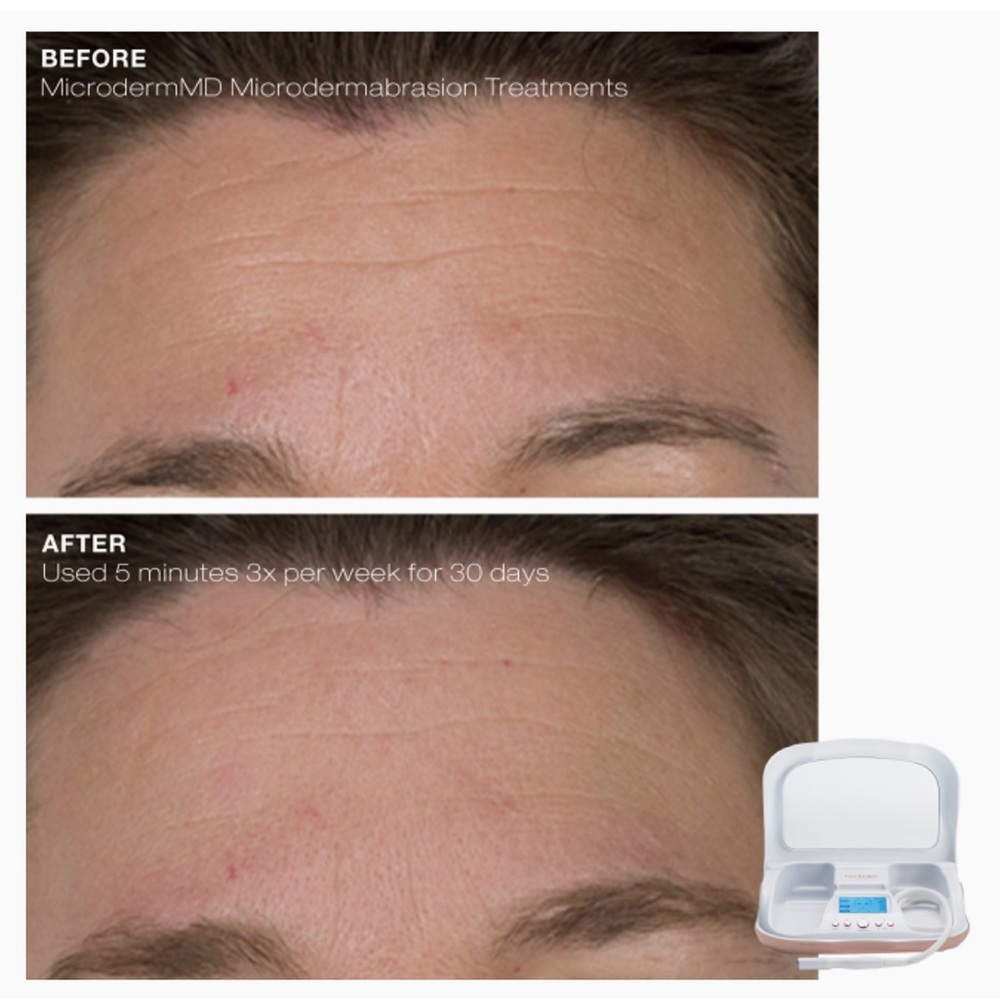 BNWT! MicrodermMD professional-grade home microdermabrasion system - Picture 5 of 5